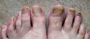 Antifungal Foot Care Serum New- https://tinyurl.com/fhtdc8w